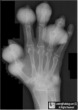 Gout hand
